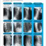 Spinal Decay Patient Form Within Chiropractic X Ray Report Template