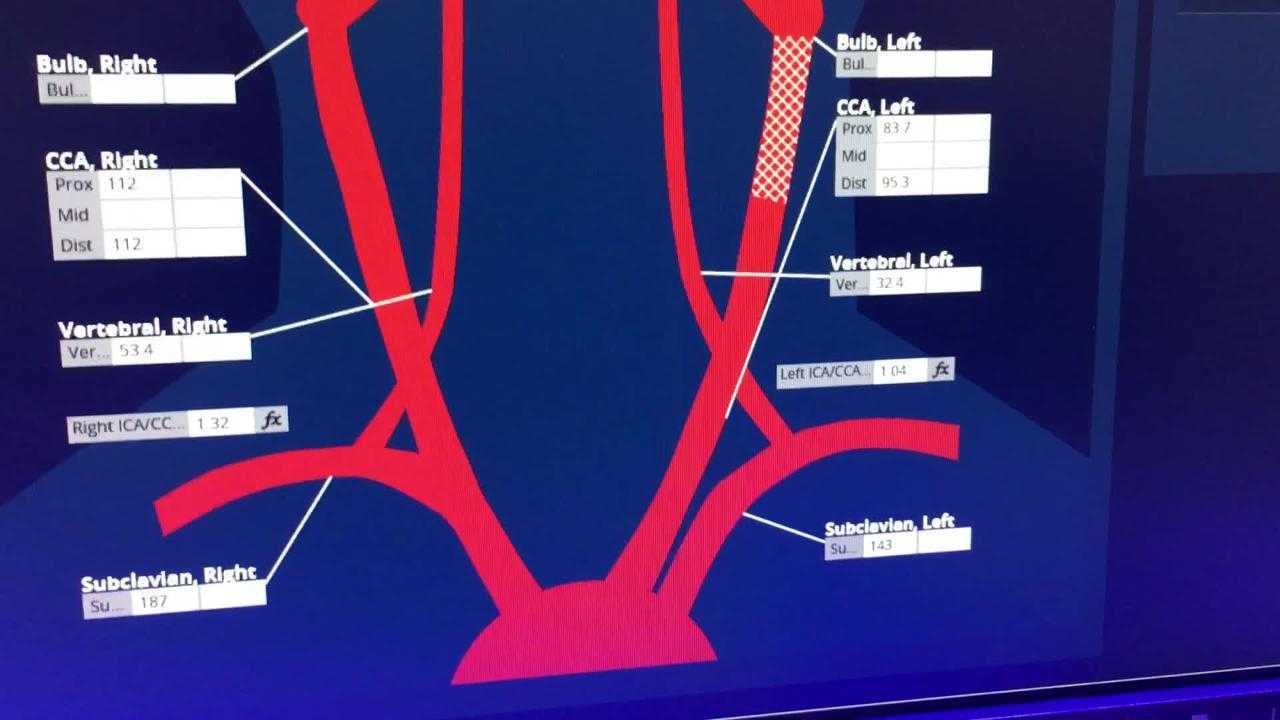 VIDEO: Carotid Artery Reporting Template Example DAIC Inside Carotid Ultrasound Report Template VIDEO: Carotid Artery Reporting Template Example DAIC Inside Carotid Ultrasound Report Template